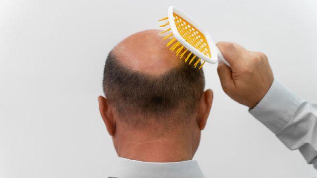 “두피에 발랐더니 풍성”…탈모약 대박에 ‘상한가’ 찍은 이곳