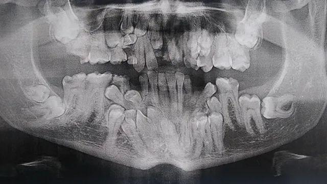 사랑니 엑스레이,,