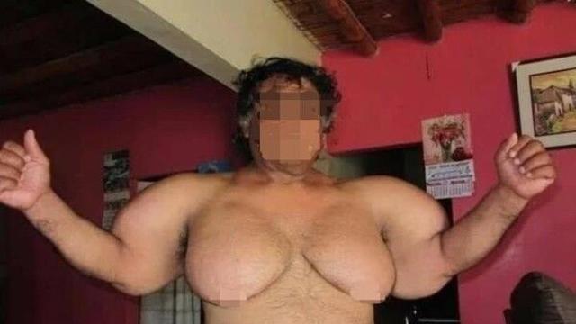 풍선처럼 부푼 몸…12년째 팽창된 몸과 싸우는 잠수부