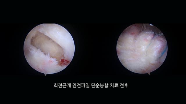 어깨 질환 '회전근개 건염' ...연세사랑병원, 