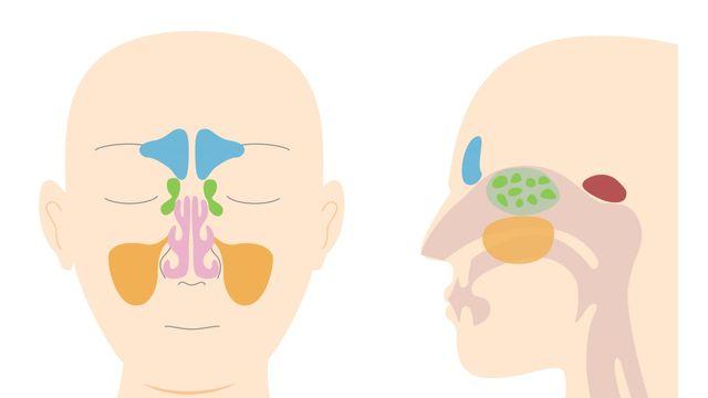 감기와 초기 증상 비슷한 ‘부비동염’, 방치 시 ‘뇌막염’ 위험
