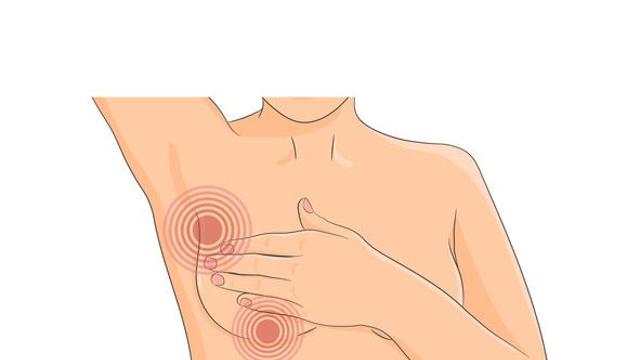 암 치료 중 많이 하는 질문 (6) 림프부종, 예방 완화법은 없나?
