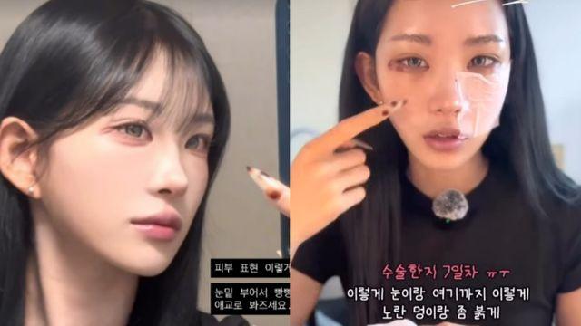 ‘故 최진실 딸’ 최준희, 또 수술 7일 차…’퉁퉁 부은’ 얼굴 공개 [RE:스타]