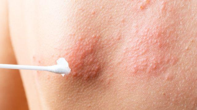 고령층에 치명적인 ‘대상포진’, 면역력 관리가 관건