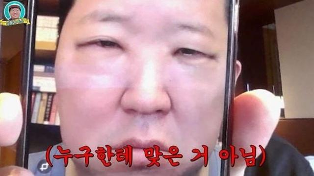 정형돈 “눈밑지방 재배치 강추”…수술 직후 붓기 사진까지 공개