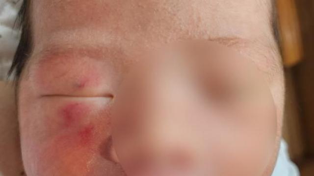 '생후 4일' 영아 얼굴에 상처…산부인과 신생아실서 무슨 일이
