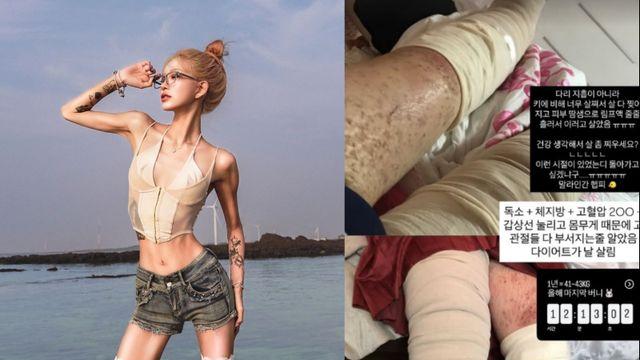 최준희, ‘루푸스 투병’ 시절 공개 “땀샘으로 림프액 줄줄…다이어트가 살려” [IS하이컷]