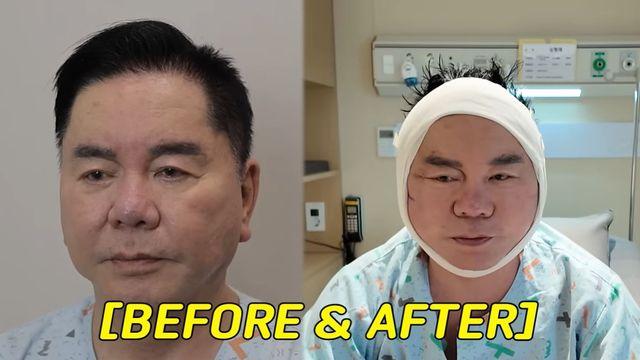 '67세' 심형래, 얼굴 싹 고쳤다…안면거상 재수술 