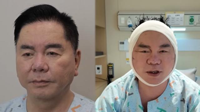 '영구' 심형래, 안면거상 재수술 후 모습 공개...팬들 위해 얼굴 리모델링 결단