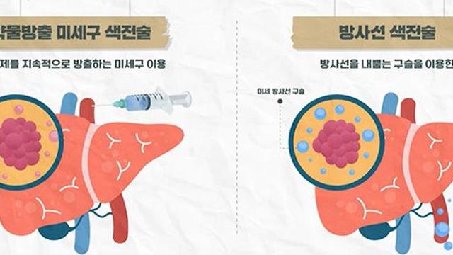 간암 치료, 수술이 먼저일까? 항암이 먼저일까?