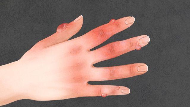 강추위에 체감온도 ‘뚝’…겨울철 ‘동상’ 예방수칙은?