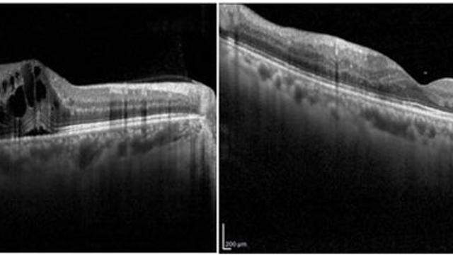 망막혈관폐쇄 환자 10년 간 66% 증가