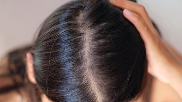 이 행동만 고쳐도 탈모 확 줄어든다… 전문의가 알려준 겨울 ‘모발 관리법’
