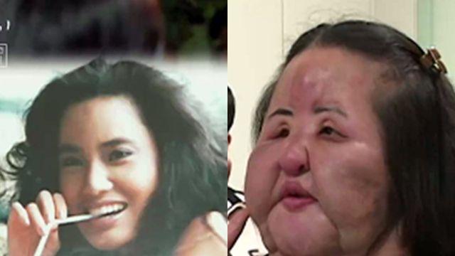 선풍기 아줌마 얼굴서 ‘공업용 실리콘→콩기름’ 4kg 나와 (꼬꼬무)[TV종합]