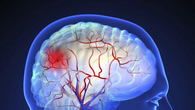 급격히 추워진 겨울철, 갑자기 찾아오는 ‘뇌졸중’ 주의