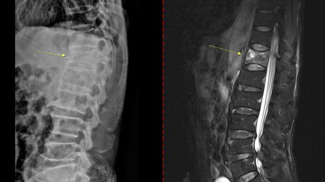 ‘침묵의 질환’ 골다공증, 고위험군은 골밀도 검사로 조기 예방해야