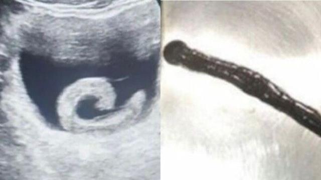 잘못된 민간요법…요도에 꿈틀거리는 '이것' 넣었다가 병원행