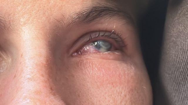 “버스 탔다가 눈 비볐을 뿐인데” 20대 女 실명…이유는?