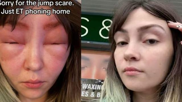 “눈썹 염색하다 ‘외계인’ 됐다”…알레르기 테스트의 중요성