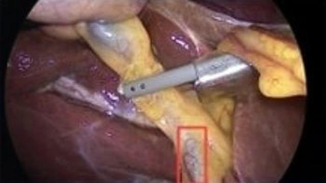 담낭절제삼각 식별 영상인식 AI모델 개발…담관 손상 최소화 및 수술시간·입원기간 감소