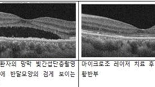 중심성망막염 新 치료 전략 제시…3개월 완전소실 80.8%