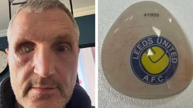 합성이 아니다…리즈 유나이티드 열성팬, ‘구단 엠블럼’ 들어간 맞춤 의안 공개…“시련을 충성심과 자부심으로”