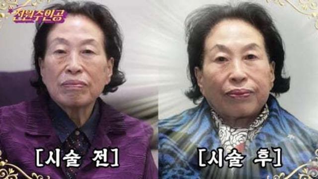 ‘87세’ 전원주, 500만 원 리프팅 시술…“10년만 젊어지고 싶다”
