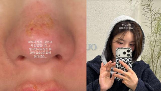 권은비, 킬리만자로 등반 후 2도 화상 