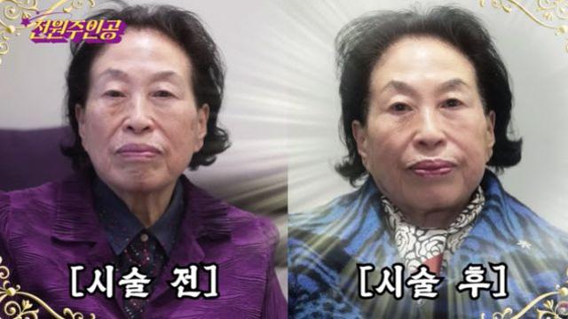 '짠순이' 전원주, 500만원 피부과 시술 받고 확 달라졌다