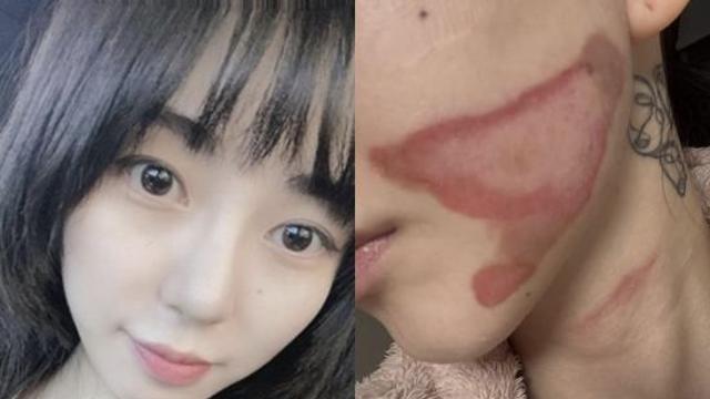 권민아, 충격적 피부 상태…