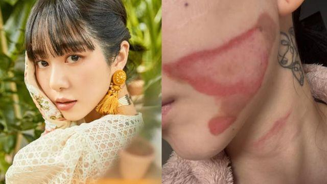 권민아, 시술로 화상 피해 호소…”찢어지는 고통+공황발작” [전문]