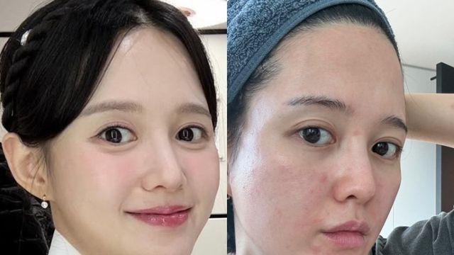 ‘6월 출산’ 남보라, 임신 중 피부질환... “이게 맞나” [IS하이컷]