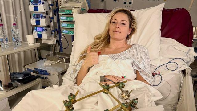 충격 또 충격! '41세 스키 여제', 다리 절단할 수도…올림픽서 복합 골절→