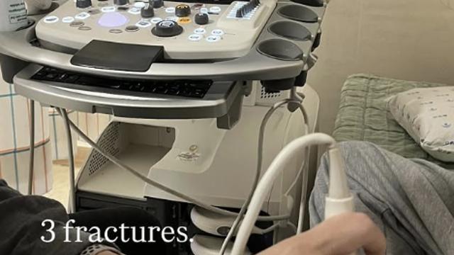 '금메달' 최가온, 골절상 진단 나왔다…SNS에 진단 결과 암시→'투혼의 올림픽 챔피언' 더더욱 감동 [2026 밀라노]