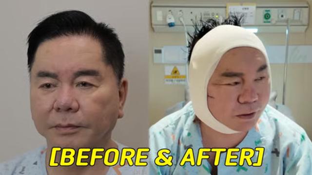 '안면거상 수술' 심형래 