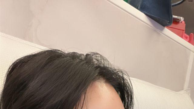 랄랄, 코수술 6일 차 확 달라진 옆모습…“좀 더 착해진 것 같기도” [IS하이컷]