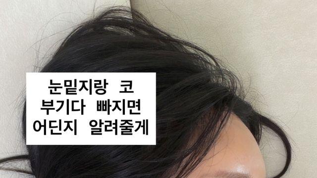 랄랄, 눈밑지방 재배치+코 재수술 성공... 달라진 옆태 [IS하이컷]
