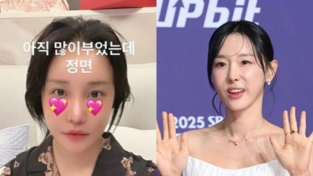 랄랄→이지혜, 성형도 콘텐츠 시대…퉁퉁 부운 얼굴도 '화제성 甲' [엑's 이슈]