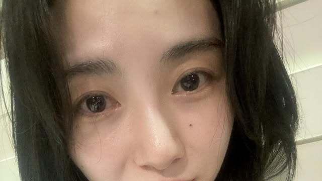 권민아 “가해자는 어디에?”…피부 시술 후 2도 화상 주장 [SD톡톡]