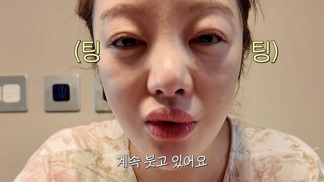 황보라, 시험관 주사 부작용으로 얼굴 ‘퉁퉁’…“온몸 붓고 각막까지 찢어져”