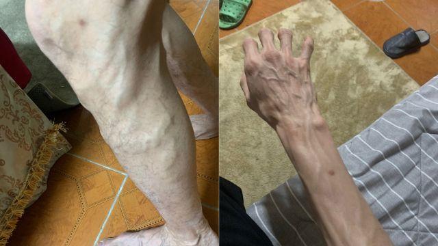 핏줄 튀어나온 팔다리, 밤새 도지는 통증에도 