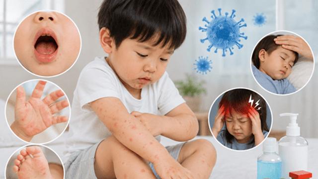 손발 발진만 보면 안 된다…수족구병, 급성이완성마비 등 신경계 합병증 주의