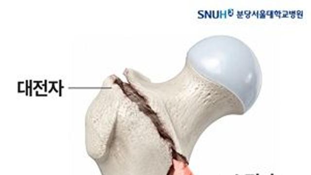 ‘고관절 골절’ 불안정한 경우…골절 부위 정확히 맞추면 수술 결과도 좋아