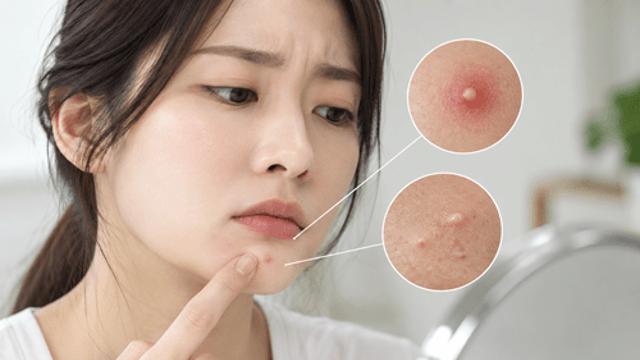 다 나은 줄 알았는데 또? 성인 여성 괴롭히는 '턱 여드름'
