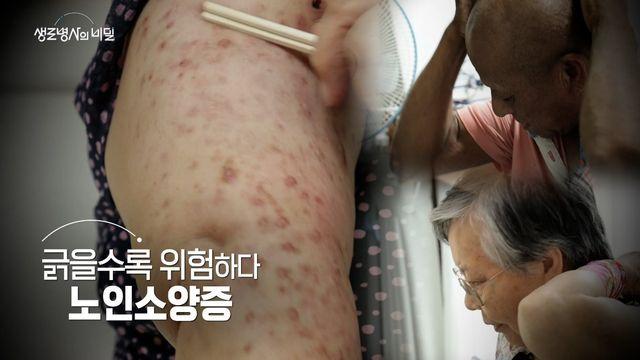 KBS1 생로병사의 비밀…지독한 가려움, 긁을수록 위험한 노인소양증