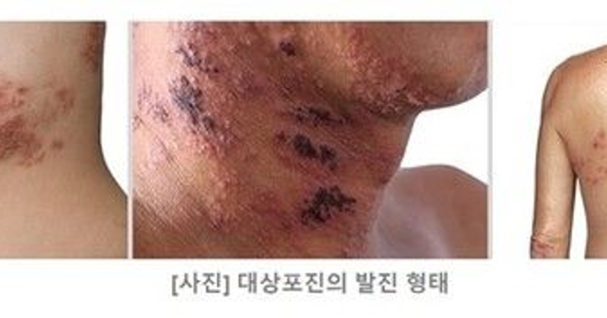 감기 몸살인줄 알았는데 대상포진…
